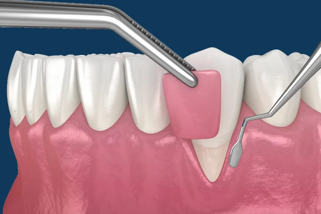 Receding gums exposing tooth roots