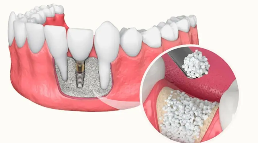 Ridge augmentation procedure