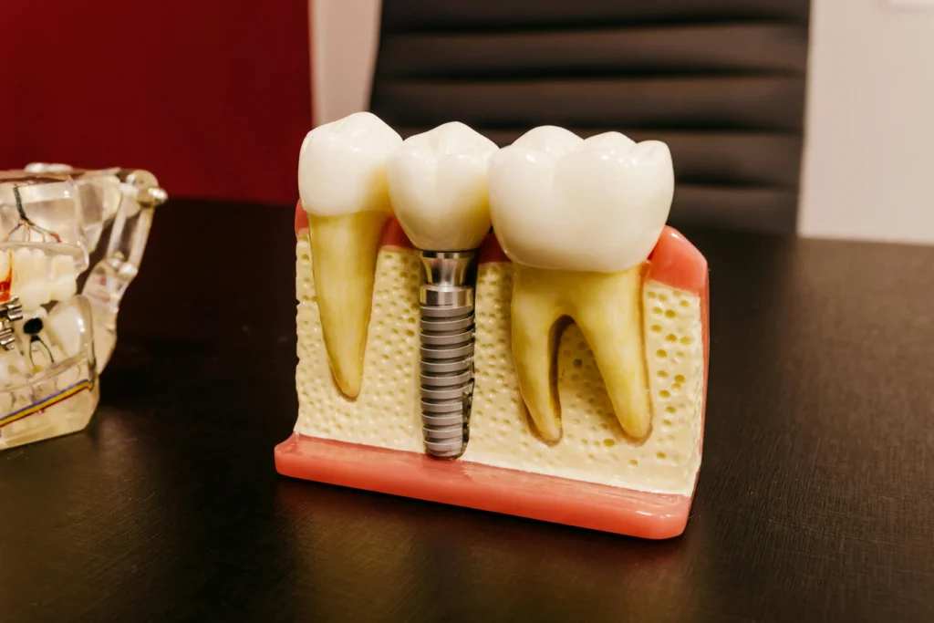 Dental implant replacing missing tooth