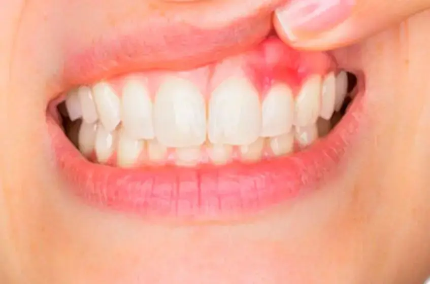 Early stage gum disease inflammation around teeth