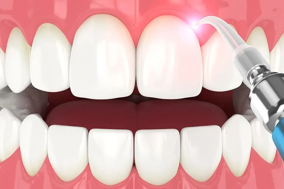 Laser gum treatment procedure