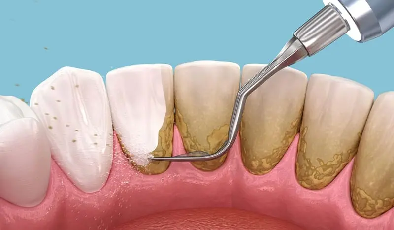 Deep cleaning procedure under gums