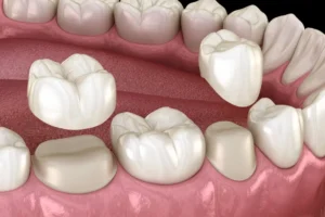 Excess gum tissue covering teeth