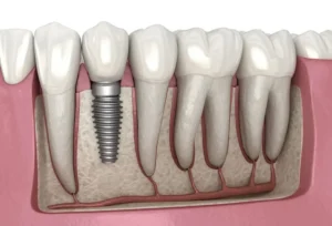 Dental implant replacing missing tooth