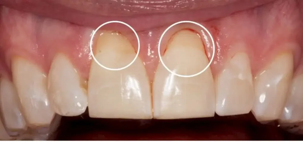 Before Gum Grafting Thin gum tissue and exposed roots before gum graft