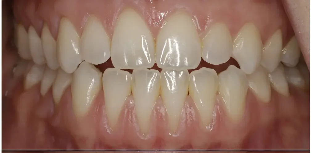 Gum Grafting Results Gum tissue restored covering tooth roots after graft