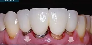 Gum Recession Before Treatment Receding gums exposing tooth roots before treatment