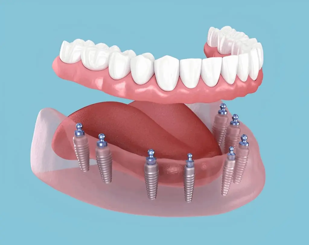 dental implant placed in jawbone 3D illustration